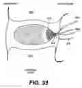 Fig. 28 - Spinal disc annulus reconstruction method and deformable spinal disc annulus stent