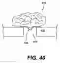 Fig. 29 - Spinal disc annulus reconstruction method and deformable spinal disc annulus stent