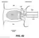 Fig. 31 - Spinal disc annulus reconstruction method and deformable spinal disc annulus stent