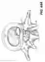 Fig. 33 - Spinal disc annulus reconstruction method and deformable spinal disc annulus stent