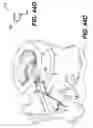 Fig. 35 - Spinal disc annulus reconstruction method and deformable spinal disc annulus stent