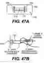 Fig. 45 - Spinal disc annulus reconstruction method and deformable spinal disc annulus stent