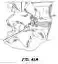 Fig. 46 - Spinal disc annulus reconstruction method and deformable spinal disc annulus stent