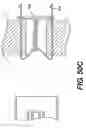 Fig. 53 - Spinal disc annulus reconstruction method and deformable spinal disc annulus stent