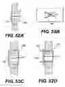 Fig. 55 - Spinal disc annulus reconstruction method and deformable spinal disc annulus stent