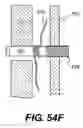 Fig. 59 - Spinal disc annulus reconstruction method and deformable spinal disc annulus stent