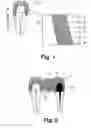 Fig. 02 - Method for making ceramic artificial dental bridges
