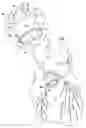 Fig. 02 - Extracardiac blood flow amplification device