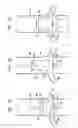 Fig. 03 - Extracardiac blood flow amplification device