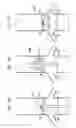 Fig. 06 - Extracardiac blood flow amplification device