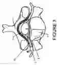 Fig. 04 - Nerve protection barrier