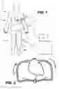 Fig. 02 - Blood pumping system