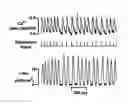 Fig. 01 - Heart rate variance cardiac pacemaker