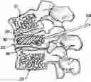 Fig. 01 - Vertebroplasty method