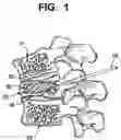 Fig. 02 - Vertebroplasty method
