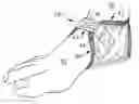 Fig. 01 - Cracked heel protector