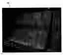 Fig. 01 - Frayless frangible connection for fabric and vertical blind system and vertical drapery system incorporating the same