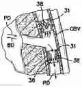 Fig. 01 - Methods and apparatus for transmyocardial direct coronary revascularization