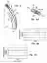 Fig. 08 - Methods and apparatus for transmyocardial direct coronary revascularization
