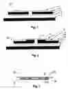 Fig. 02 - Ostomy appliance