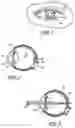 Fig. 02 - System and method for aligning an optic with an axis of an eye