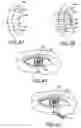 Fig. 08 - System and method for aligning an optic with an axis of an eye