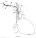 Fig. 02 - High flow diffusion catheter