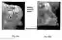 Fig. 22 - System,apparatus and method for large area tissue ablation