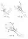 Fig. 02 - Method and device for uterine fibroid treatment