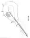Fig. 08 - Method and device for uterine fibroid treatment