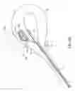 Fig. 16 - Method and device for uterine fibroid treatment