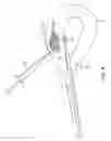 Fig. 19 - Method and device for uterine fibroid treatment