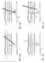 Fig. 08 - Methods and apparatus for coagulating and/or constricting hollow anatomical structures