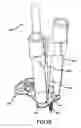 Fig. 31 - All through one drill guide for cervical plating