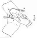 Fig. 06 - Transobturator surgical articles and methods