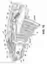 Fig. 10 - Electrosurgical hemostat
