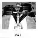 Fig. 02 - System and method for aligning vertebrae in the amelioration of aberrant spinal column deviation conditions