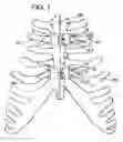 Fig. 06 - Sternum closure device having locking member