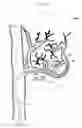 Fig. 06 - Balloon catheter