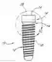 Fig. 01 - Implant with internal multi-lobed interlock
