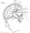 Fig. 02 - Endoscopic sheath having a biomimetic retractor