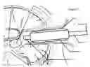 Fig. 04 - Endoscopic sheath having a biomimetic retractor