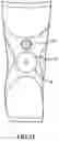 Fig. 12 - Orthotic or prosthetic devices with adjustable force dosimeter and sensor