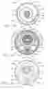 Fig. 11 - Method and apparatus for emboli containment