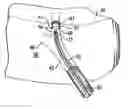 Fig. 01 - Device and method for intra-bronchial provision of a therapeutic agent