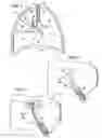 Fig. 03 - Device and method for intra-bronchial provision of a therapeutic agent