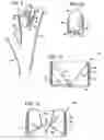 Fig. 05 - Device and method for intra-bronchial provision of a therapeutic agent