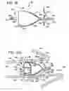 Fig. 07 - Device and method for intra-bronchial provision of a therapeutic agent