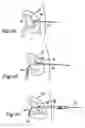 Fig. 11 - Drainage catheter