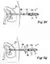 Fig. 13 - Drainage catheter